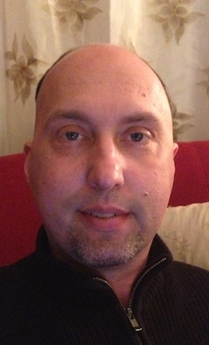 Steroids swelling my face.